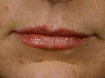 Botox