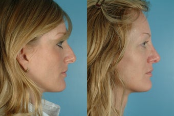  revision rhinoplasty