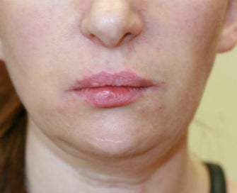 Filler in nasolabial folds (Juvederm)