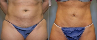 43 year old female with mini tummy tuck