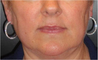Juvederm