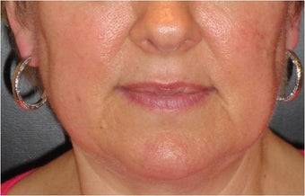 Juvederm