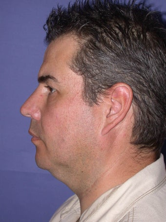 Neck Lift