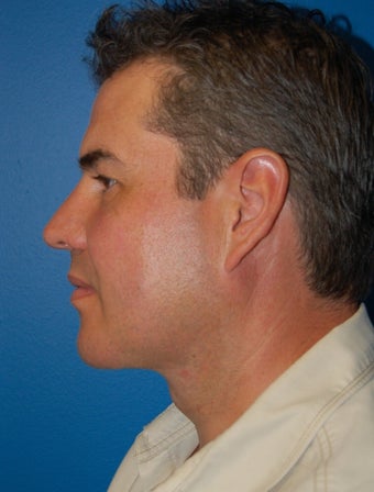 Neck Lift