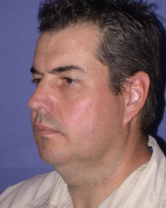 Neck Lift