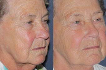 Before & After IPL Photo Facial
