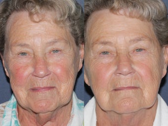 Before & After IPL Photo Facial