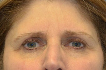 Endoscopic Browlift, SMAS Facelift and Necklift, Chin Implant
