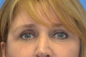 Endoscopic Browlift, SMAS Facelift and Necklift, Chin Implant