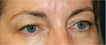 Eye Bag Surgery