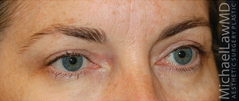 Eye Bag Surgery