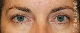 Eye Bag Surgery