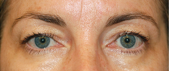 Eye Bag Surgery