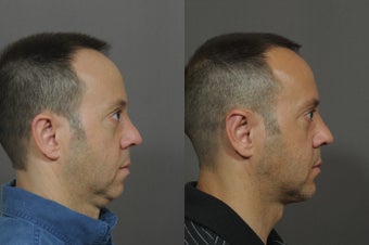 Chin Implant and Neck Tightening