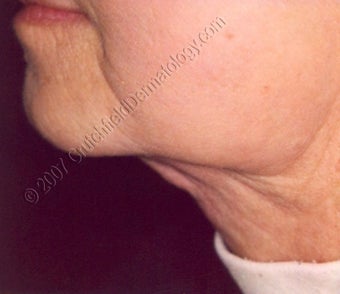 LipoDissolve injections to neck fat