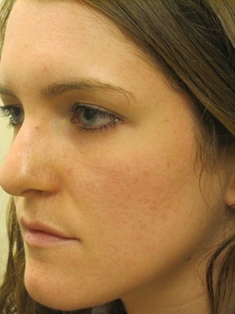 Acne Scars Laser Surgery