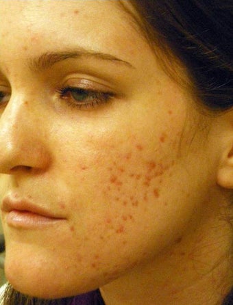 Acne Scars Laser Surgery