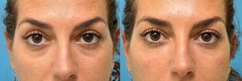 Tear Trough Fillers - Microcannula Technique