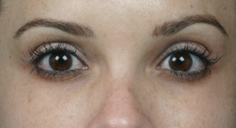 Latisse for Eyelashes
