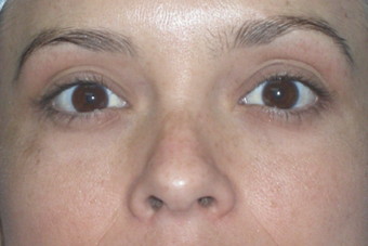 Latisse for Eyelashes