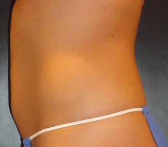 SmartLipo MPX