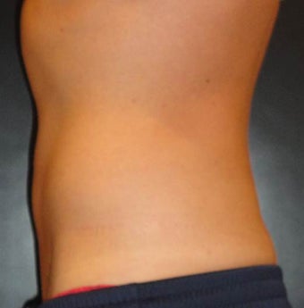 SmartLipo MPX