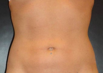 SmartLipo MPX