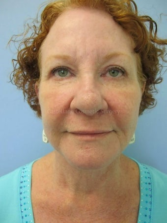 Woman, facelift and BOTOX procedure