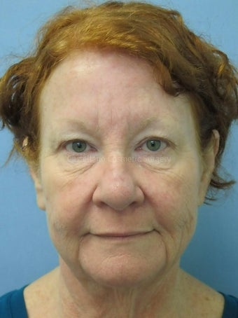 Woman, facelift and BOTOX procedure