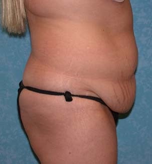 Circumferential Body Lift