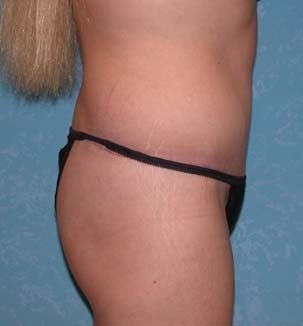 Circumferential Body Lift