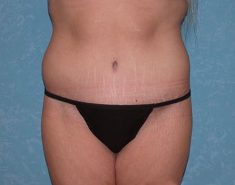Circumferential Body Lift