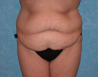 Circumferential Body Lift