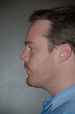 Chin Augmentation