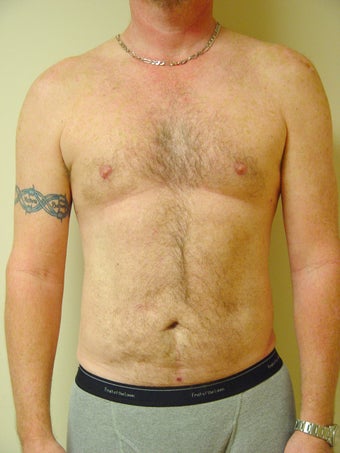 Laser Liposuction