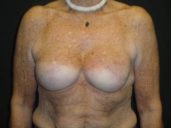Implant-based breast reconstruction
