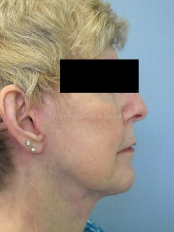 Woman, fillers used to lift cheeks