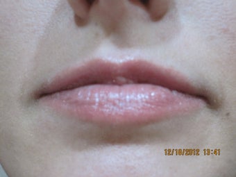 26 Year Old Female Treated for Lip Enhancement