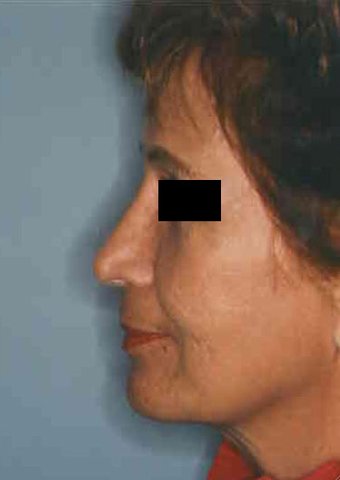 Revision Rhinoplasty
