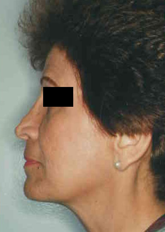 Revision Rhinoplasty
