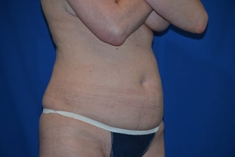 liposonix treatment for waist reduction