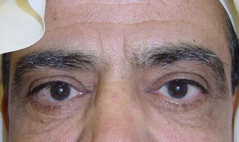 Lower Blephroplasty