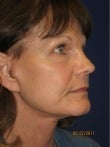 Female patient treated for jowls and neck laxity