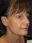 Female patient treated for jowls and neck laxity