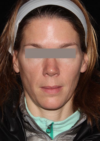 Female patient before and after Botox.