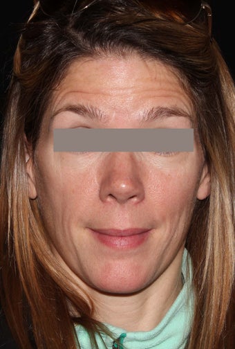 Female patient before and after Botox.