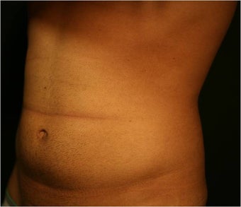SmartLipo MPX