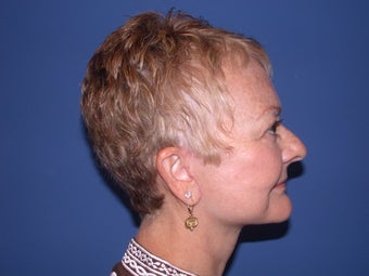 Neck lift