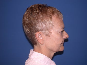 Neck lift