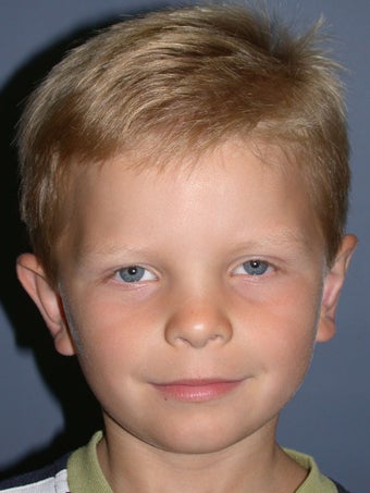 Otoplasty/Ear Surgery